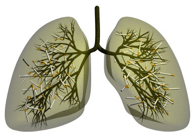 Smoker's lung