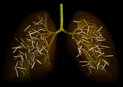 Smoker's lung