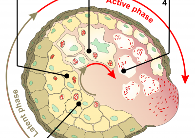 Tuberculosis: formation and decay of tubercles